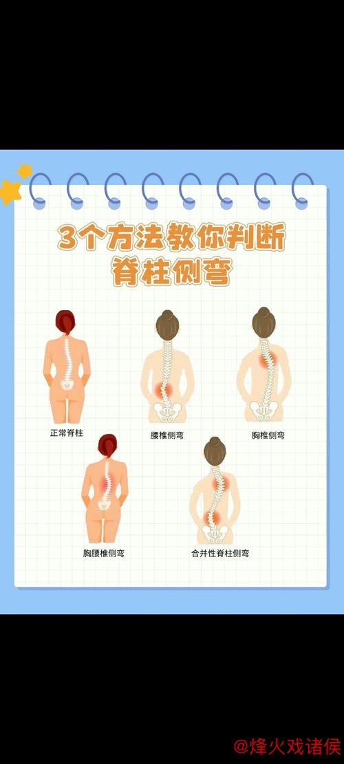 1分钟科普站丨青少年脊柱侧弯预防 这2个动作超有效 1分钟科普站丨青少年脊柱侧弯预防 这2个动作超有效